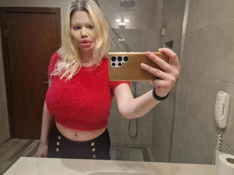 Žena s najvećim usnama na svijetu zabrinjava liječnike: 'Može doći do komplikacija'