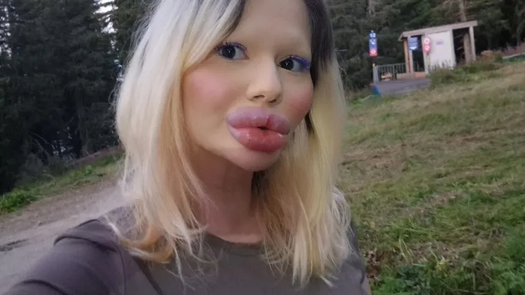 Žena s najvećim usnama na svijetu zabrinjava liječnike: 'Može doći do komplikacija'