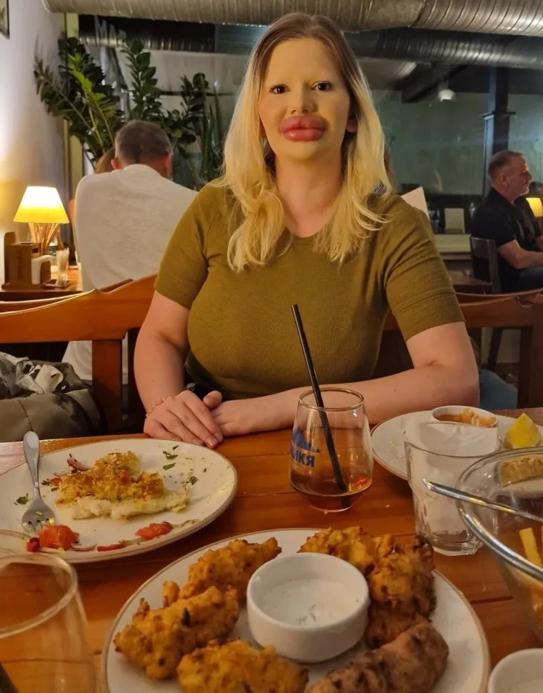 Žena s najvećim usnama na svijetu zabrinjava liječnike: 'Može doći do komplikacija'