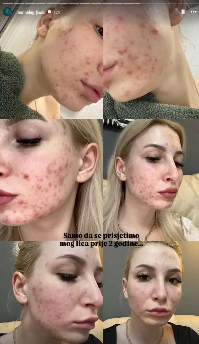 Marinela iz Gospodina Savršenog pokazala kako joj je lice izgledalo prije dvije godine