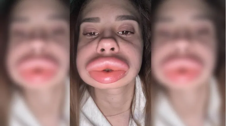 Pokušala je ispumpati usne i postigla kontraefekt, ispred očiju joj se odvio horor