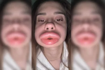 Pokušala je ispumpati usne i postigla kontraefekt, ispred očiju joj se odvio horor