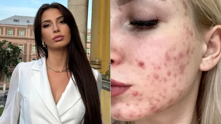 Marinela iz 'Gospodina Savr&scaron;enog' otkrila kako joj je izgledalo lice: '&Scaron;minku sam stavljala i kad sam i&scaron;la baciti smeće'