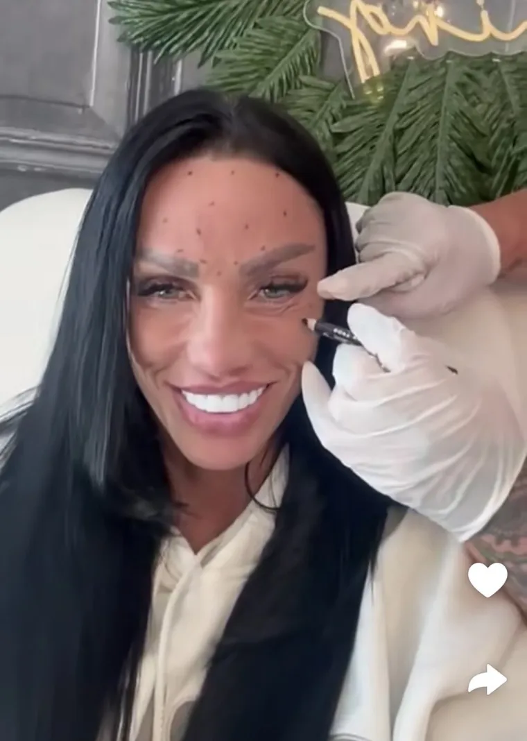 Biv&scaron;a manekenka pokazala neobične izbočine na čelu nakon tretmana botoksom