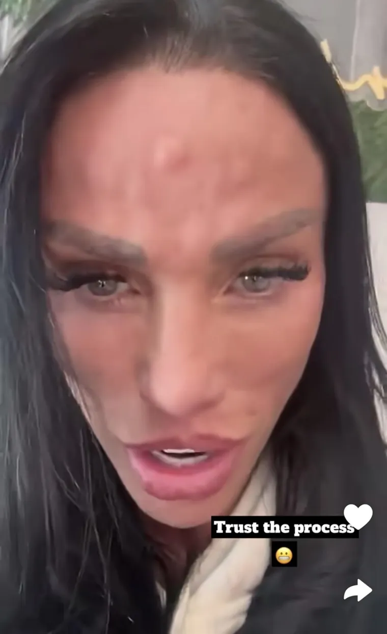 Biv&scaron;a manekenka pokazala neobične izbočine na čelu nakon tretmana botoksom