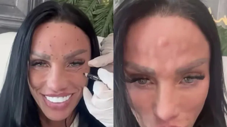 Biv&scaron;a manekenka pokazala neobične izbočine na čelu nakon tretmana botoksom