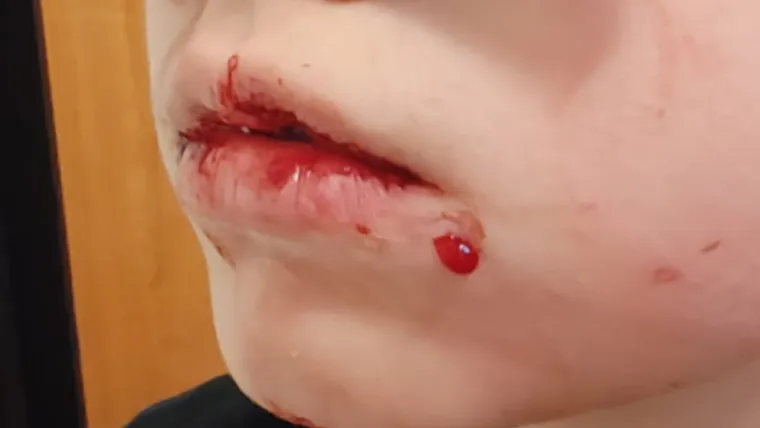 Ovo je dječak kojeg su pretukli u Zagrebu. Majka: 'Da su ga bokserom pogodili malo više...'