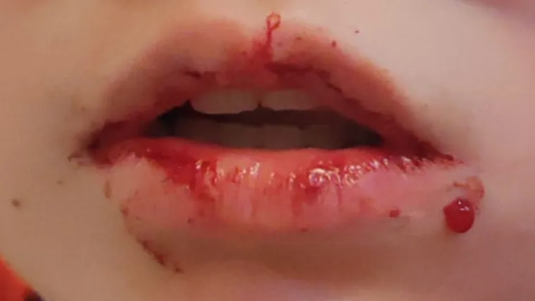 Ovo je dječak kojeg su pretukli u Zagrebu. Majka: 'Da su ga bokserom pogodili malo više...'