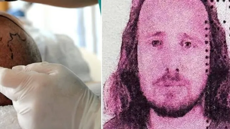 Još jedan muškarac (36) umro nakon transplantacije kose u Turskoj: Samo se srušio