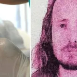 Još jedan muškarac (36) umro nakon transplantacije kose u Turskoj: Samo se srušio