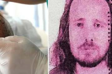 Još jedan muškarac (36) umro nakon transplantacije kose u Turskoj: Samo se srušio