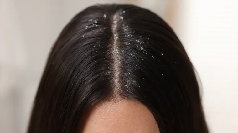 Recite zbogom peruti: Najbolji lijekovi za zdravu kosu nalaze se u vašem ormariću