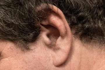 S godinama dlake počinju rasti tamo gdje ih ne želimo: Postoje načini da ih se riješimo