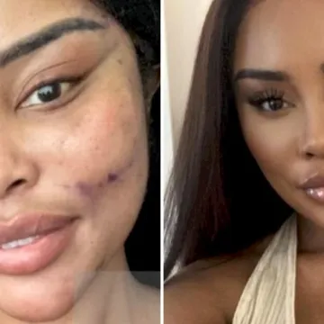 Od njezine transformacije padaju vilice: Potrošila masnu lovu, ovako izgleda danas