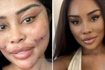 Od njezine transformacije padaju vilice: Potrošila masnu lovu, ovako izgleda danas