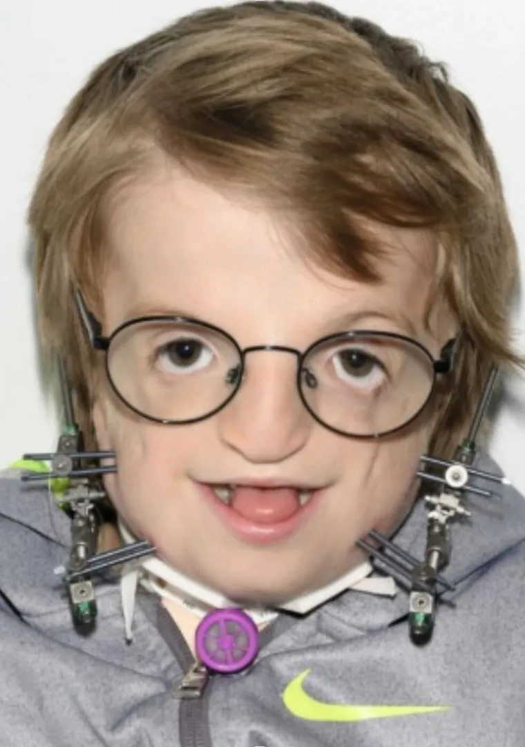 Inovativnim zahvatom na čeljusti spasili dječaka: 'Jedva čekam spavati kod prijatelja'