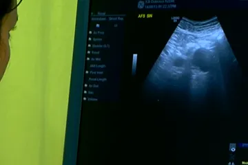 Rak gušterače ubije 800 ljudi godišnje: Razgovarali smo s onima koji su 'na prvoj crti'