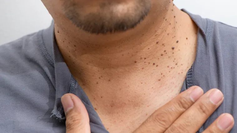 Dermatologinja o izraslinama na licu ili vratu: 'Nemojte ih skidati samostalno'