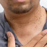 Dermatologinja o izraslinama na licu ili vratu: 'Nemojte ih skidati samostalno'