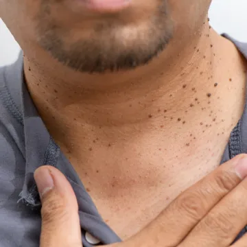 Dermatologinja o izraslinama na licu ili vratu: 'Nemojte ih skidati samostalno'