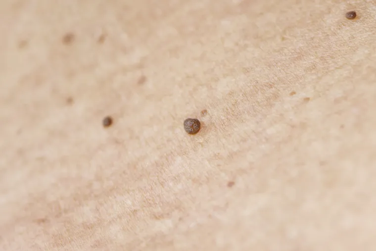 Dermatologinja o izraslinama na licu ili vratu: 'Nemojte ih skidati samostalno'