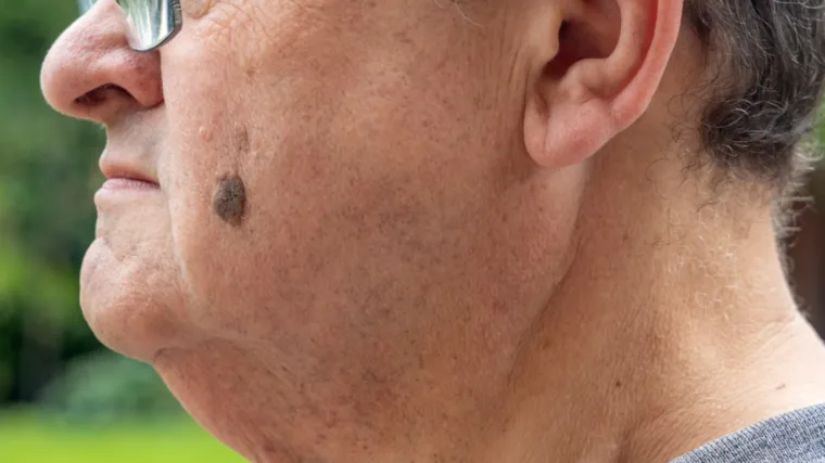 Dermatologinja objasnila kako nastaje jedna od najče&scaron;ćih promjena na koži: 'I genetika ima ulogu'