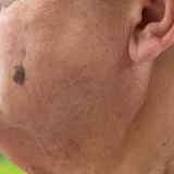 Dermatologinja objasnila kako nastaje jedna od najče&scaron;ćih promjena na koži: 'I genetika ima ulogu'