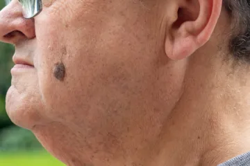 Dermatologinja objasnila kako nastaje jedna od najče&scaron;ćih promjena na koži: 'I genetika ima ulogu'