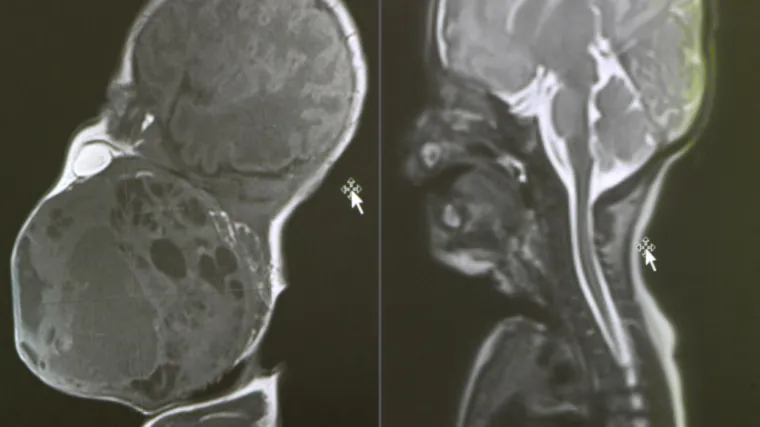 Hrvatski liječnici napravili čudo: Bebi usred porođaja izvadili tumor veličine glave