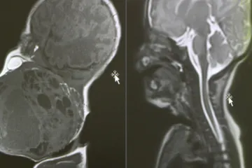 Hrvatski liječnici napravili čudo: Bebi usred porođaja izvadili tumor veličine glave