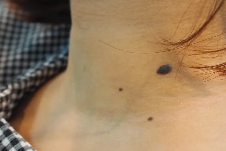 Dermatologinja objasnila kako nastaje jedna od najče&scaron;ćih promjena na koži: 'I genetika ima ulogu'