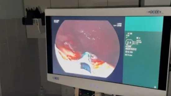 Dvije pacijentice uspješno se oporavljaju nakon revolucionarnog zahvata na želucu