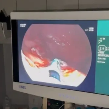 Dvije pacijentice uspješno se oporavljaju nakon revolucionarnog zahvata na želucu