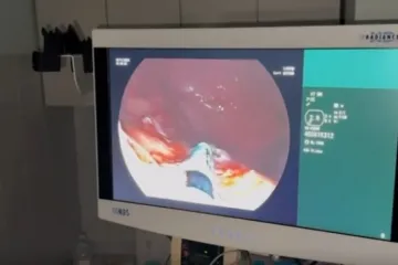 Dvije pacijentice uspješno se oporavljaju nakon revolucionarnog zahvata na želucu