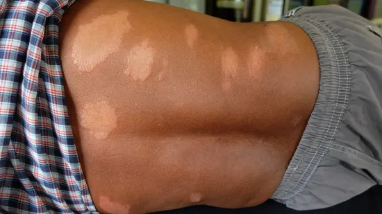 Znate li kada je bio posljednji slučaj gube u Hrvatskoj?