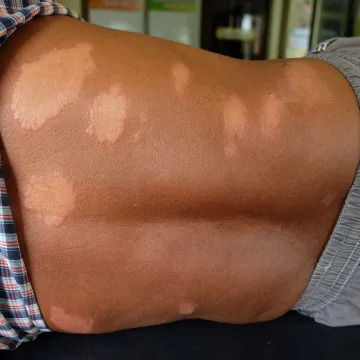 Znate li kada je bio posljednji slučaj gube u Hrvatskoj?