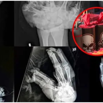 Ogromna zapljena pirotehnike &scaron;okirala Hrvatsku, kirurg: 'Djeca ostaju s ozljedama zauvijek'