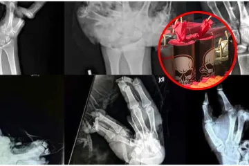 Ogromna zapljena pirotehnike &scaron;okirala Hrvatsku, kirurg: 'Djeca ostaju s ozljedama zauvijek'