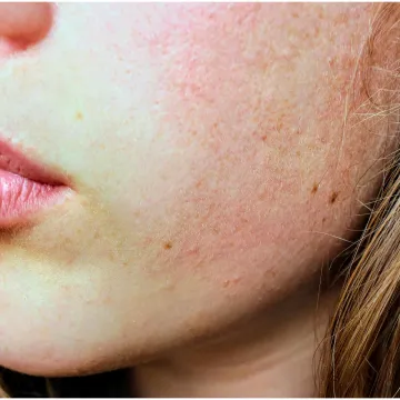 Dermatolozi upozoravaju na viralni trend njege kože: 'Dugoročno uzrokuje ozbiljnu &scaron;tetu'