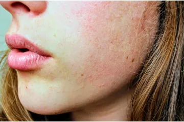 Dermatolozi upozoravaju na viralni trend njege kože: 'Dugoročno uzrokuje ozbiljnu &scaron;tetu'