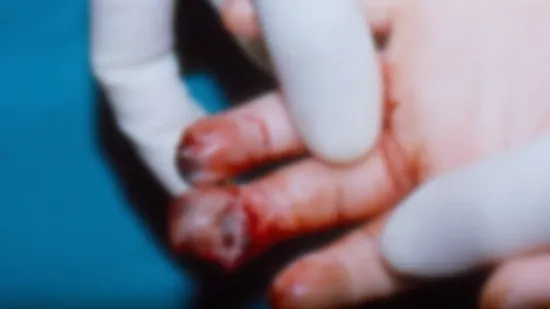 Eksplodirala mu u ruci i raznijela prste: Tko je odgovoran za nesreću dječaka(10) iz Osijeka?