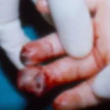 Eksplodirala mu u ruci i raznijela prste: Tko je odgovoran za nesreću dječaka(10) iz Osijeka?