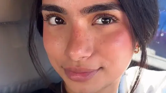 Snimila je na licu muku koja mnogim curama stvara nelagodu, video skupio 30 milijuna pregleda