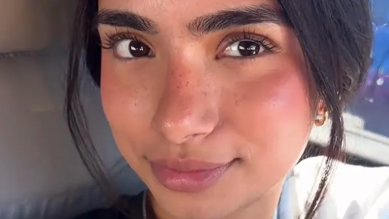 Snimila je na licu muku koja mnogim curama stvara nelagodu, video skupio 30 milijuna pregleda