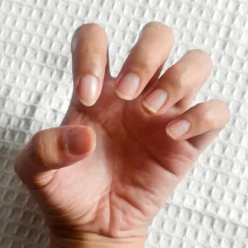 Jednostavan test prstima mogao bi pomoći u ranom otkrivanju raka pluća: 'Važno je ovo'