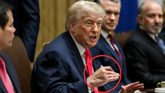 Trump progovorio o modricama na ruci: 'Svaki dan pijem ovaj lijek, i to u većoj dozi'