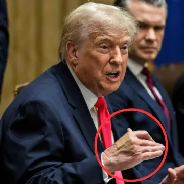 Trump progovorio o modricama na ruci: 'Svaki dan pijem ovaj lijek, i to u većoj dozi'