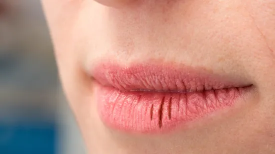 Usne su vam suhe i ispucane? Za&scaron;tite ih jednostavno uz ove trikove