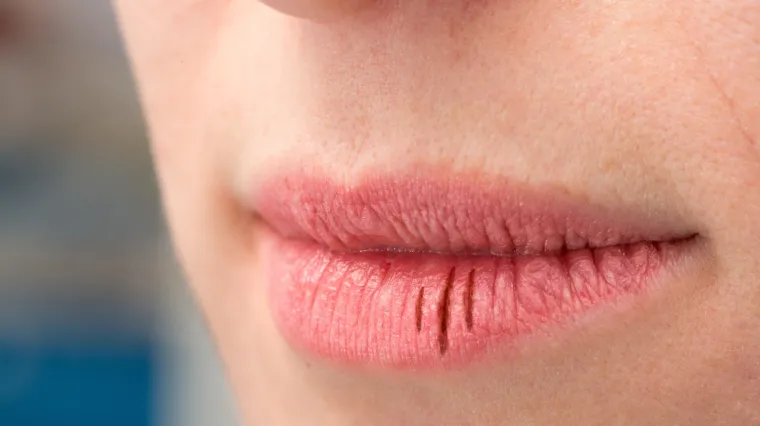 Usne su vam suhe i ispucane? Za&scaron;tite ih jednostavno uz ove trikove