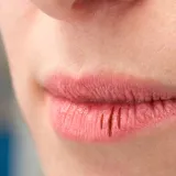 Usne su vam suhe i ispucane? Za&scaron;tite ih jednostavno uz ove trikove